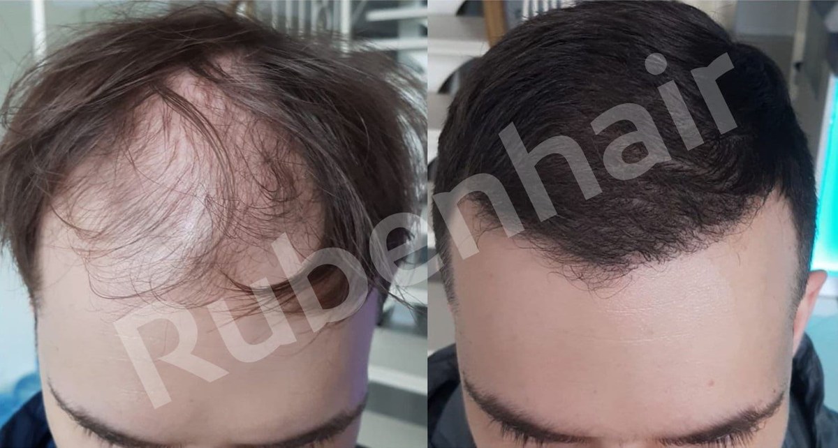 Wiederherstellung der frontalen Haarlinie — Vorher / Nachher