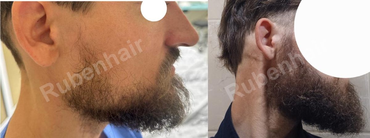 Barthaartransplantation — Vorher / Nachher