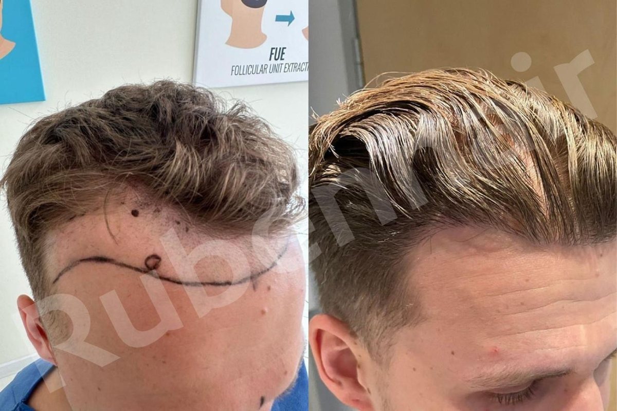 Rekonstruktion der Haarlinie — Vorher / Nachher