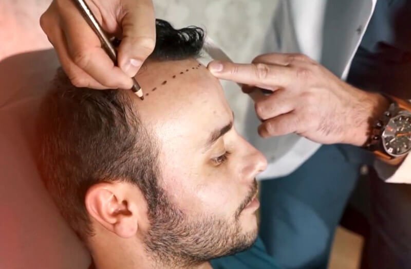 FUE-Haartransplantation
